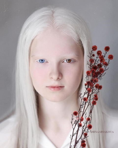 Красота чеченской девочки с альбинизмом и гетерохромией восхитила пользователей сети