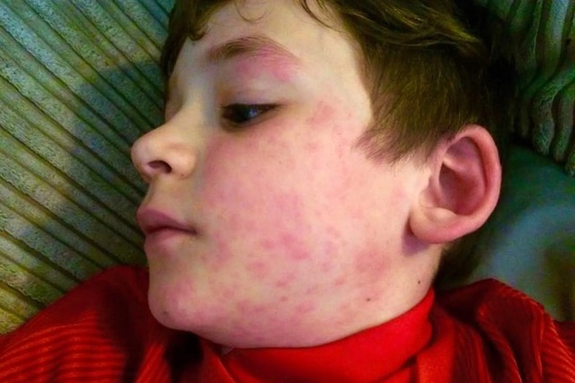 Мальчик с ужасной аллергией на холод