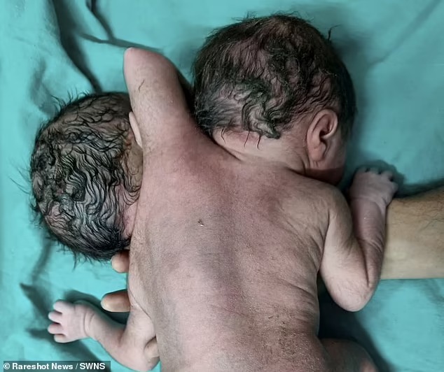 Ребенок с двумя головами и тремя руками родился в Индии