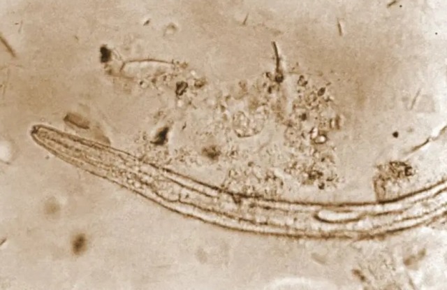 В Испании работник канализации заразился опасными тропическими червями, ползающими под кожей