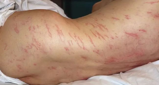 В Испании работник канализации заразился опасными тропическими червями, ползающими под кожей