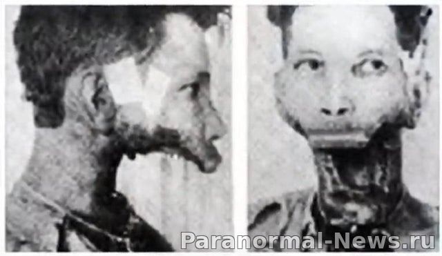 Человек, который пил радиоактивное лекарство, пока не отвалилась нижняя челюсть