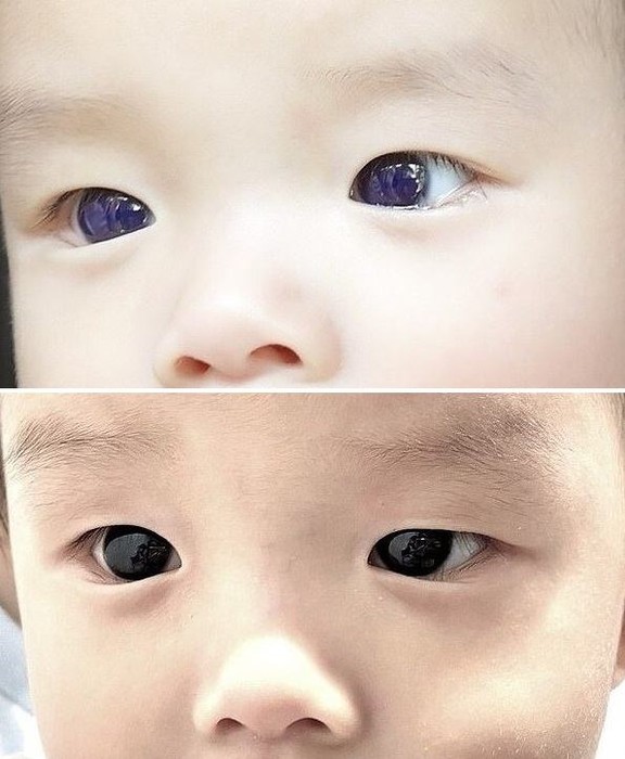 👀 Карие глаза ребенка стали синими после приема лекарства от COVID